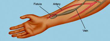 DIALYSIS ACCESS